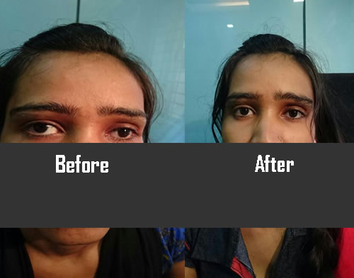squint Surgery  in indore